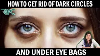 Dark Circle| By Dr Nazia Dermatologist | Rehman Medical Center | Islamabad | Blue Area