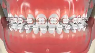 Missing Laterals Incisors Closing Spaces with Drill Center