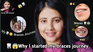 🦷😱 Why I Started My Braces Journey || My Braces Journey 🦷😁 #bracesjourney 