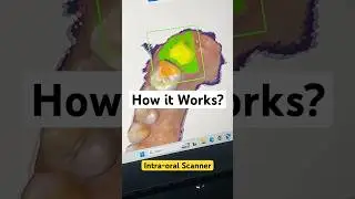 How Intra oral Scanner Works?(HIGH TECH APPROACH) #technology