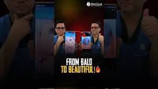 Unbelievable Hair Regrowth Transformation! 🔥 | Hair Transplant in Delhi | SkinQure