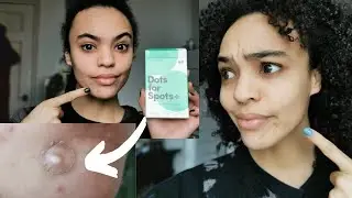 Dots For Spots Review | Do Spot Patches Really Work?