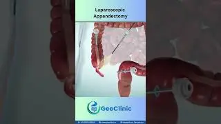 The preferred method is Laparoscopic Appendectomy, offering faster recovery and minimal scarring.