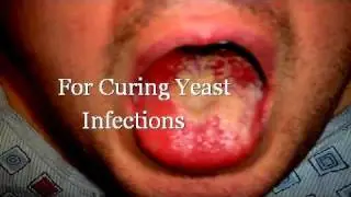 Curing Yeast Infections With Apple Cider Vinegar
