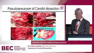 BEC 2025  Treatment of carotid dissection  Klaus Mathias