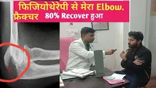 Elbow Fracture Physiotherapy / Patient Review for post operative /Best Physio Centre at Prayagraj