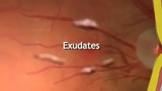 Diabetes mellitus - retinal conditions