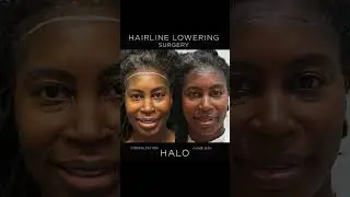 HAIRLINE LOWERING SURGERY - Before & After