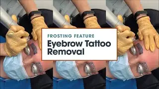 ❄ Frosting Feature ❄ Eyebrow Tattoo Removal | Removery