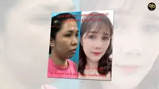 PHẪU THUẬT H&Agrave;M H&Ocirc; (PHẦN 2) _ PHƯƠNG PH&Aacute;P WASSMUND(nhổ 4R4)
