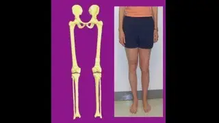 Correction of a valgus and short femur
