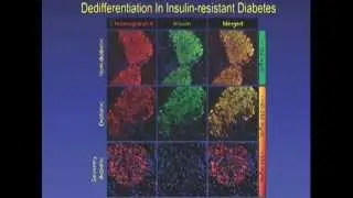 Pancreatic Beta Cell Dedifferentiation as a Mechanism of Diabetic Beta Cell Failure