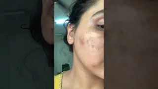 Best serum for pigmentation , review after 2weeks #viral #trending #makeup #foxtale