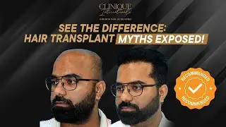 Forget the Myths! See Real Hair Transplant Results After 7 Months