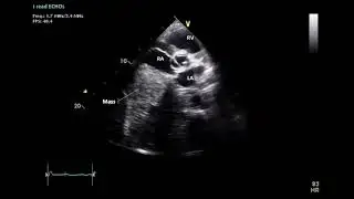 Lung Cancer Direct Left Atrium Invasion - SAX 2D