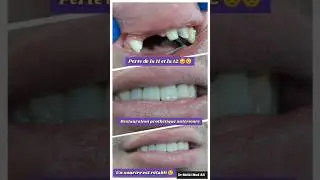 Bridge dentaire en c&eacute;ramique ant&eacute;rieure #dentist #dentiste