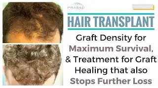 Hair Transplant - Why Hair Graft Density Should be Limited to Ensure Graft Survival