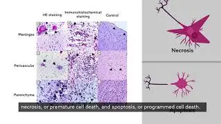 Immune response & cell damage in fatal cases of microcephaly by Zika virus (English captions)