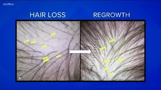 East Texans battle long-haul COVID-19 side effect &mdash; hair loss
