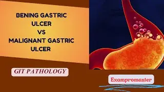 Benign vs Malignant Gastric Ulcer: Easy Explanation | GIT pathology | Robbins