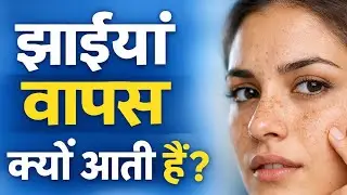 हजारों की क्रीम लगा ली, फिर भी झाइयां (Melasma) क्यों नहीं जा रहीं? Pigmentation Treatment Mistakes.