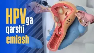 Bachadon boʻyni saratonining oldini olishda HPVga qarshi emlash eng samarali usul