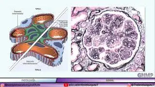 Glomerulonefritis membranoproliferativa (GNMP)