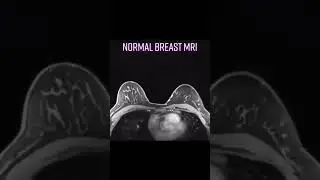 Normal breast MRI