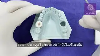 Direct pulp capping with calcium hydroxide