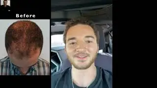 Bethesda, Maryland Natural Hair Transplant | Can a hair transplant restore a youthful appearance?