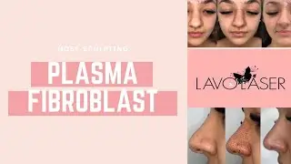 PLASMA FIBROBLAST NOSE SCULPTING VLOG