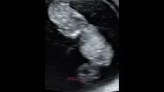Acrania-Exencephaly #fetal #NTD #NeuralTubeDefects