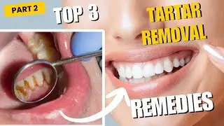 Tartar removal from teeth | Tartar removal | Calculus removal | #dentaldoubts #plaque