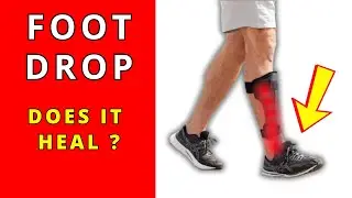 L5 S1 Disc Herniation with Foot Drop Recovery without surgery