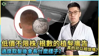 低價不限株/根數的植髮廣告真的可以相信嗎？過度取髮後會長什麼樣子？｜生髮植髮專家柯博桓醫師