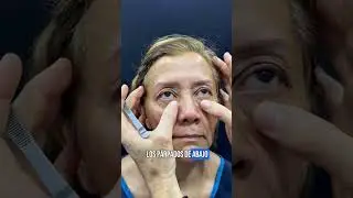 PINCH BLEPHAROPLASTY