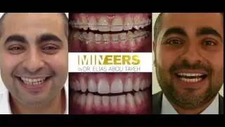 White Bracket Aligners Beirut Lebanon | Dr Elias Abou Tayeh | +9613757127 | Mineers Smile Center