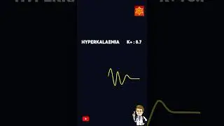 ECG Changes During Hyperkalemia #sarathiclasses #sarathi #msn #balwantnagar #nursing #nagarsir #ecg