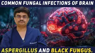 Common Fungal Infections of Brain- Aspergillus and&nbsp;Black&nbsp;Fungus Dr.Roopesh Kumar
