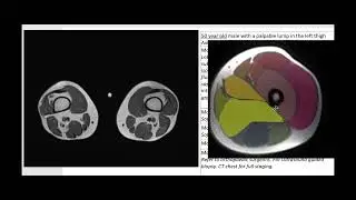 Left thigh soft tissue sarcoma MRI presented as a palpable thigh lump