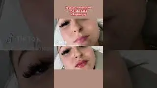 belles l&egrave;vres faites &agrave; la clinique khaoula #clinic#botoxinjection#injection#lipfiller#filler#goal