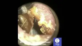 EARWAX REMOVAL WITH SKIN PEEL