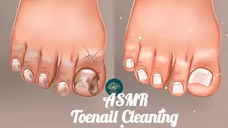ASMR Fungal Nail Treatment | Deep Cleaning & Relaxing Nail Care Animation | Oddly Satisfying Sounds