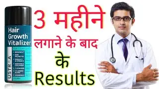 Ustraa Hair Growth Vitalizer HONEST Review 2022 In Hindi | results, benefits, uses, price info