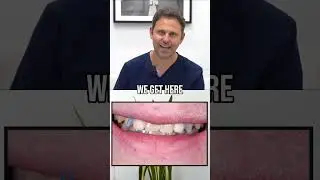 Congenitally Missing Lateral Incisors?