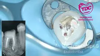 Root canal treatment from filling to coronal seal #endodontic #dentistry by drg. M. Furqan,SpKG