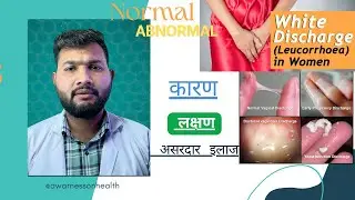 White Discharge (Leucorrhea):कब Normal, कब Danger? | Causes, Types, & Treatment #education #facts