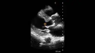 Concentric Left Ventricular Hypertrophy (LVH) - Ultrasound Image Interpretation
