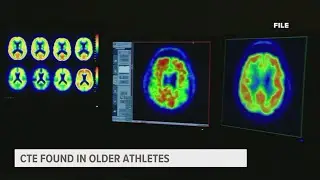 Cases of CTE rising in young athletes, causing memory loss and confusion