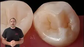 3&omicron; Style Italiano Endodontics &ldquo;Endo Resto&rdquo;